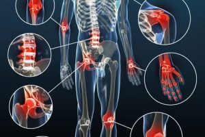 Osteoarthritis